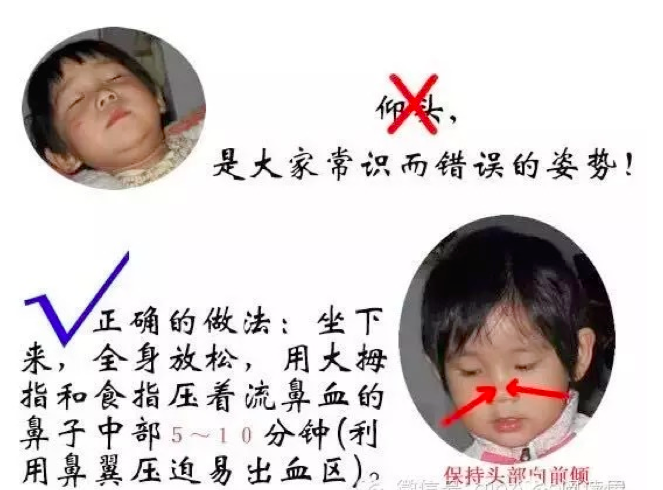 孩子流鼻血后仰头、棉花止血都不对（最正确的处理方法）-幼师课件网第2张图片